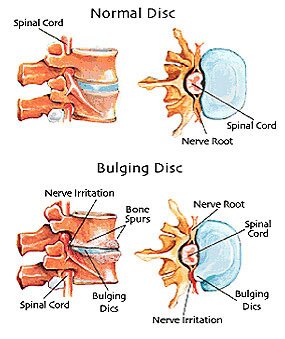 Normal Disk and Bulging Disk diagram